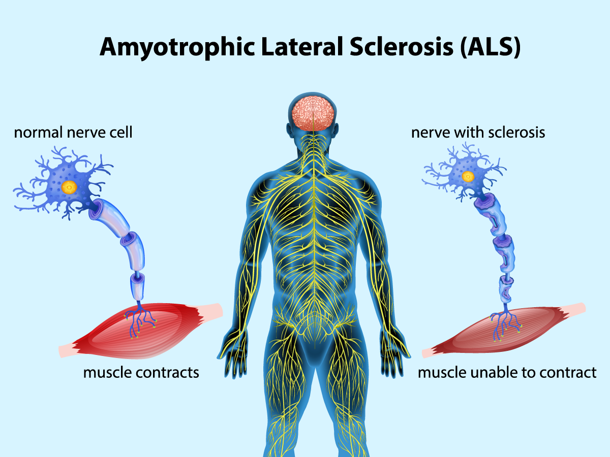 Understanding ALS Disease: Symptoms, Causes, and Treatment..