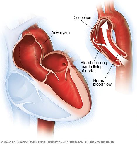 Expert Aortic Valve Replacement Surgery