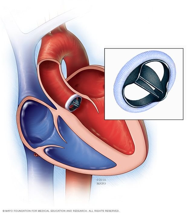 Understanding Bicuspid Aortic Valve Disease: Causes