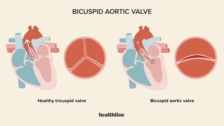 Understanding Bicuspid Aortic Valve: Causes, Symptoms