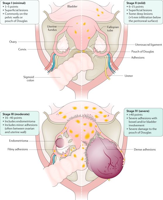 Understanding Endometriosis: Causes, Symptoms