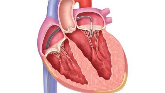 Comprehensive Guide to Mitral Valve Regurgitation: Causes