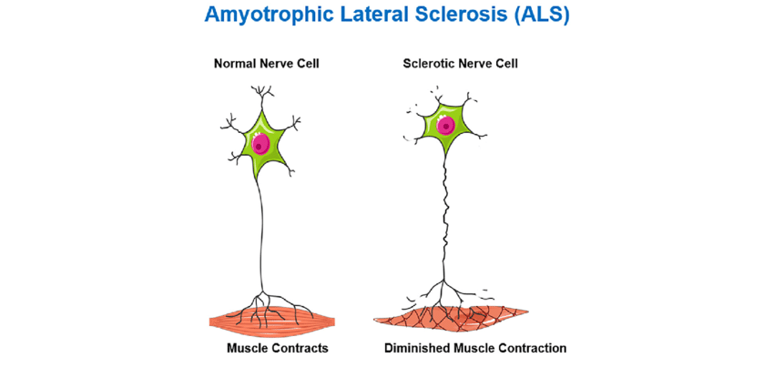 Causes and Risk Factors of ALS