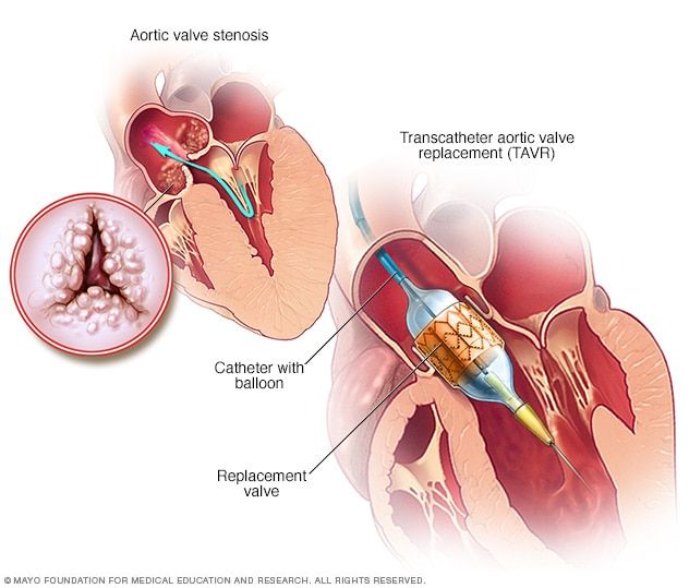 Expert Heart Valve Replacement Surgery Services