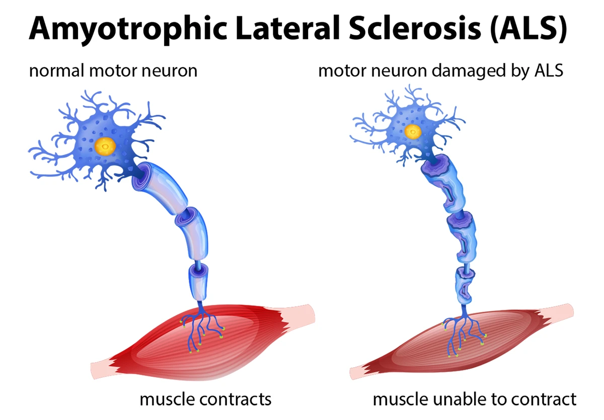 Understanding Amyotrophic Lateral Sclerosis: Causes,…