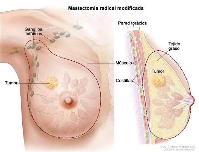 Effective Treatment for Breast Carcinoma – Expert